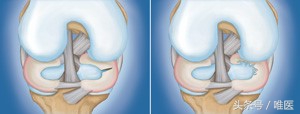 半月板损伤科普,膝盖半月板撕裂软骨脱落