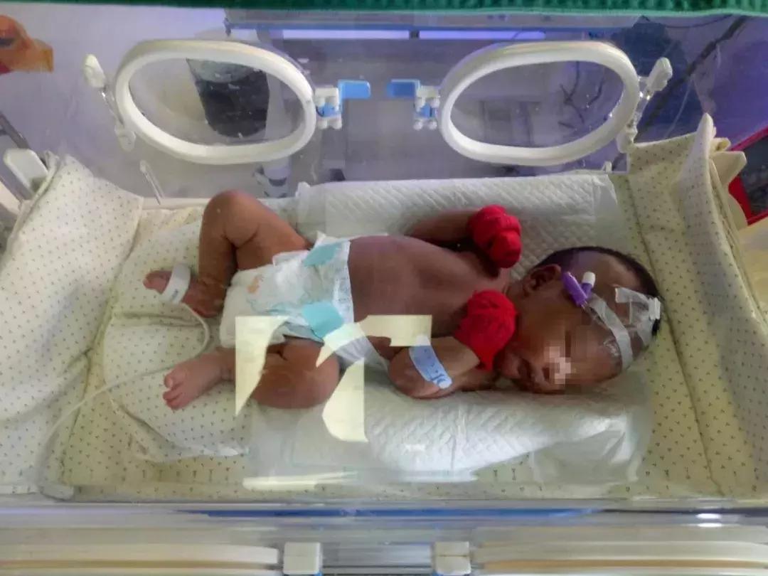 黄疸最怕的克星是什么,急性黄疸最怕什么