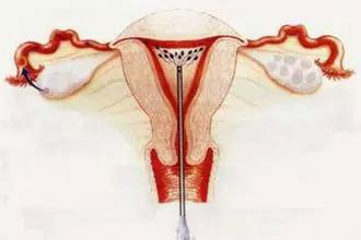 绝经后，子宫也会给你发出“警报”