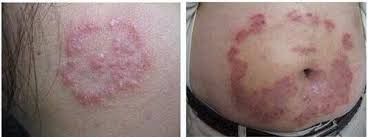 猫皮癣传染人,猫狗癣传染人有什么症状