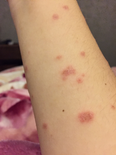 猫皮癣传染人,猫狗癣传染人有什么症状