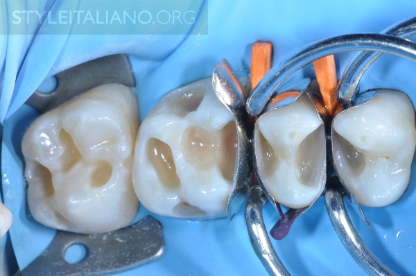 后牙修补贴片,后牙全瓷修复图片