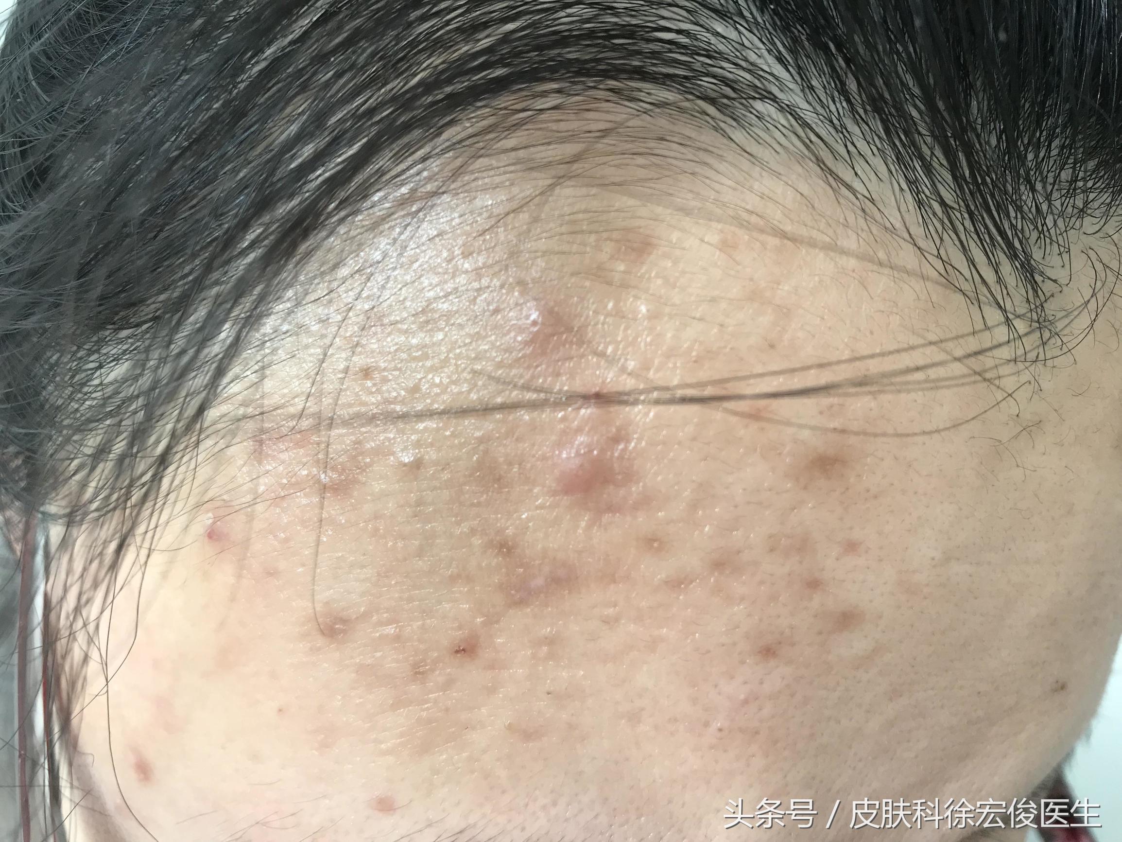 哪种类型的皮肤病能用激素,激素治疗皮肤病荨麻疹