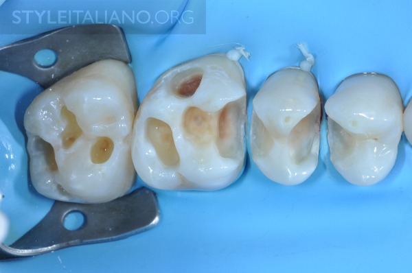 后牙修补贴片,后牙全瓷修复图片