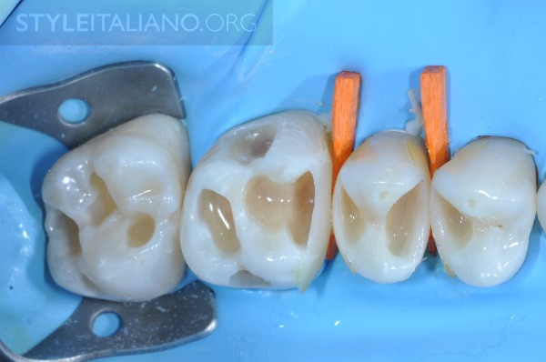 后牙修补贴片,后牙全瓷修复图片