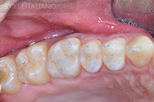 后牙修补贴片,后牙全瓷修复图片