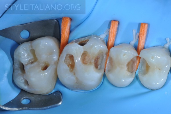 后牙修补贴片,后牙全瓷修复图片