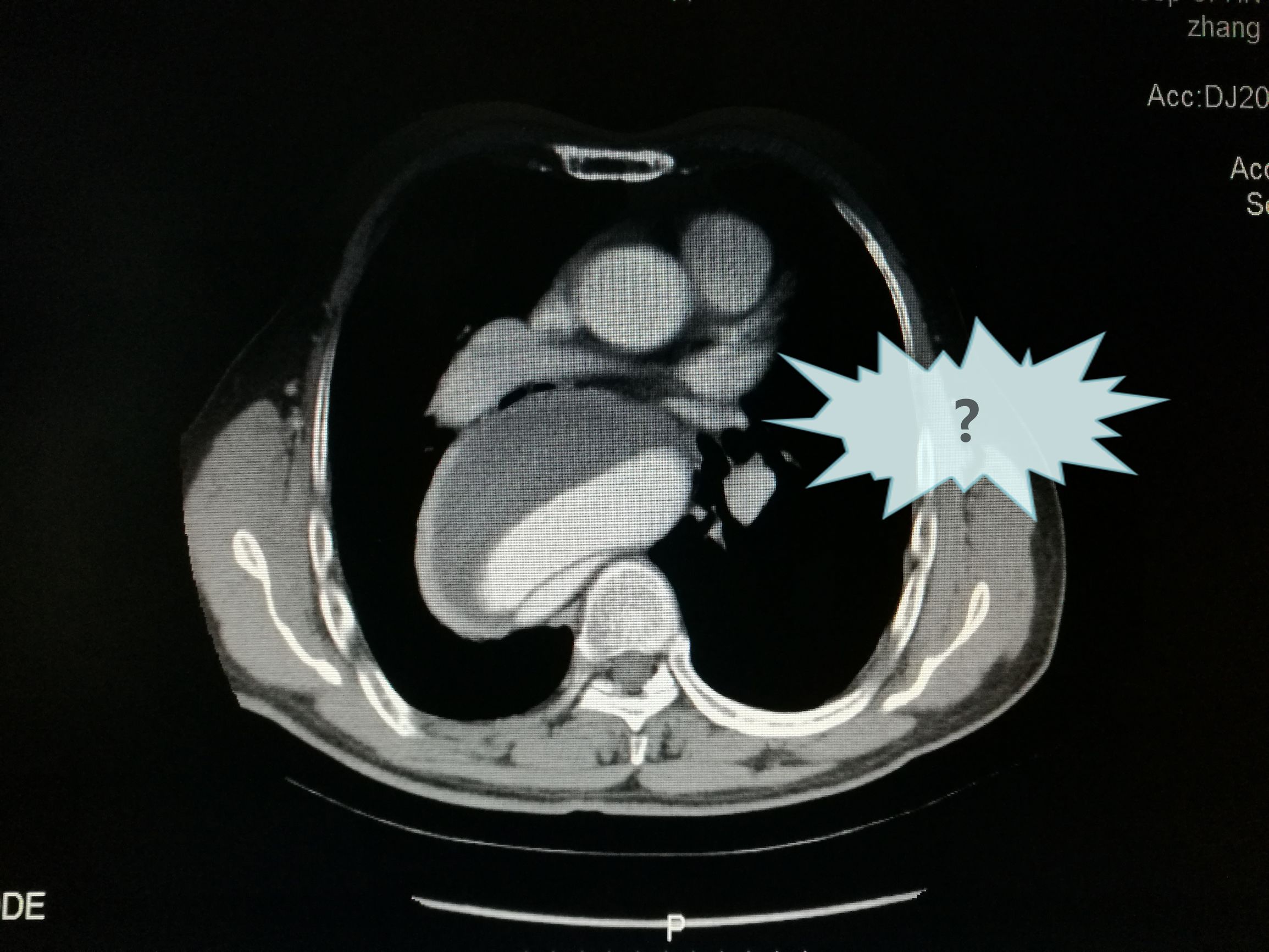 一例凶险主动脉夹层的超声诊断,慢性夹层直径超过5厘米