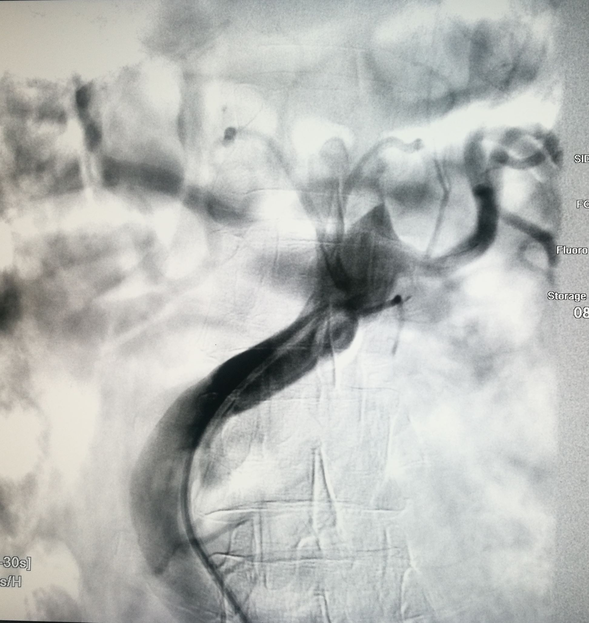 一例凶险主动脉夹层的超声诊断,慢性夹层直径超过5厘米