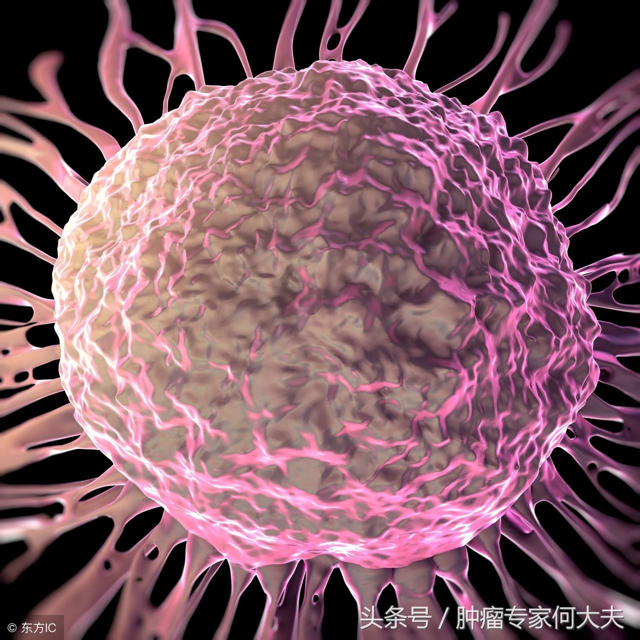 腿肿是癌症的表现么,腿肿居然是淋巴瘤引起的