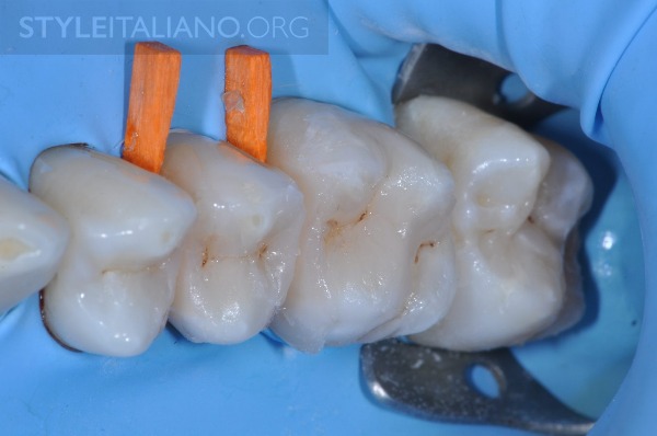 后牙修补贴片,后牙全瓷修复图片