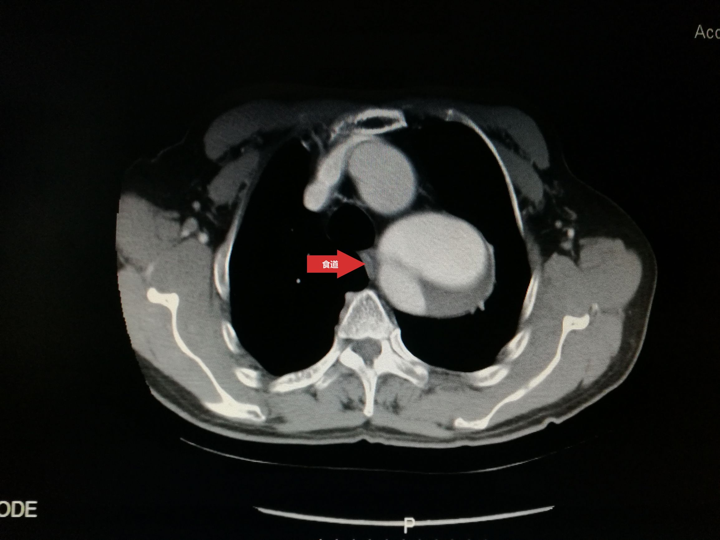 一例凶险主动脉夹层的超声诊断,慢性夹层直径超过5厘米