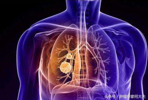 腿肿是癌症的表现么,腿肿居然是淋巴瘤引起的