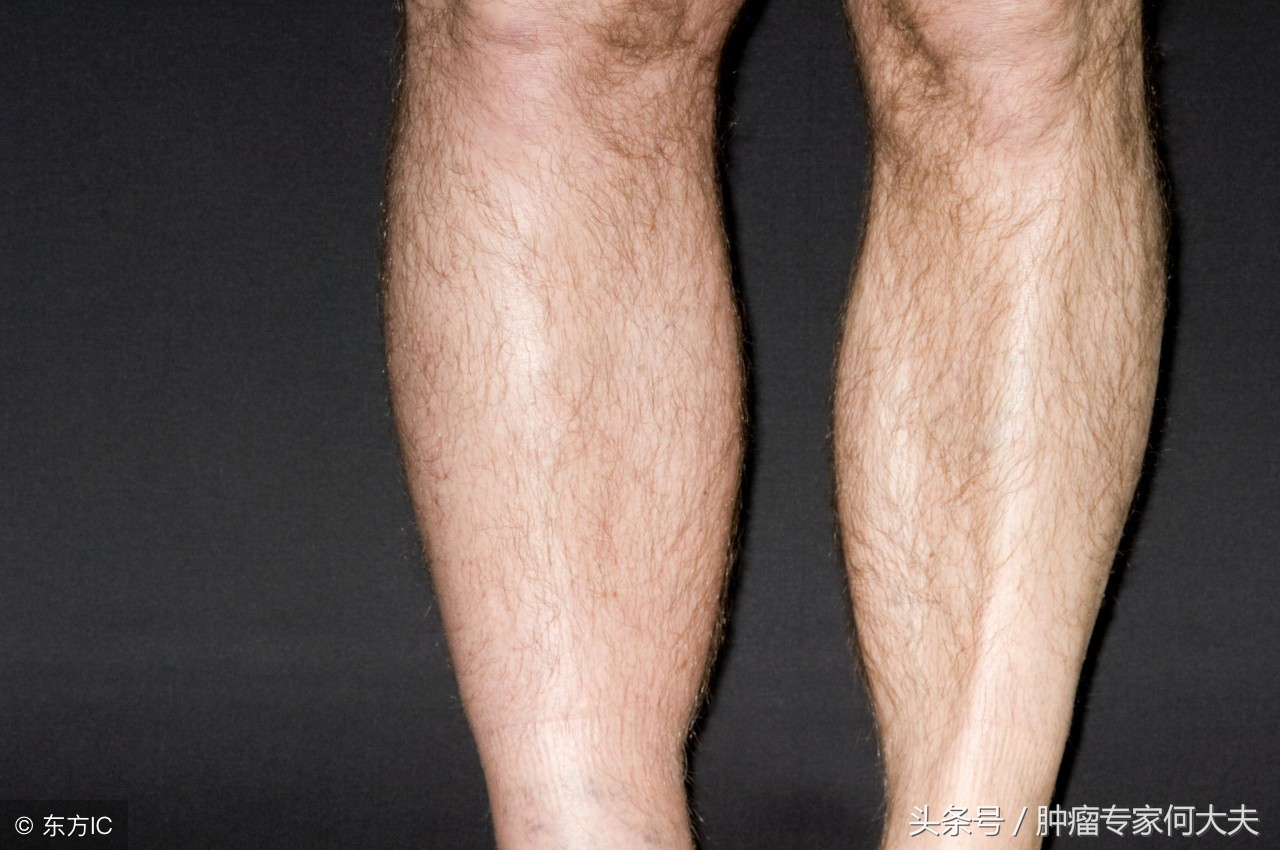 腿肿是癌症的表现么,腿肿居然是淋巴瘤引起的