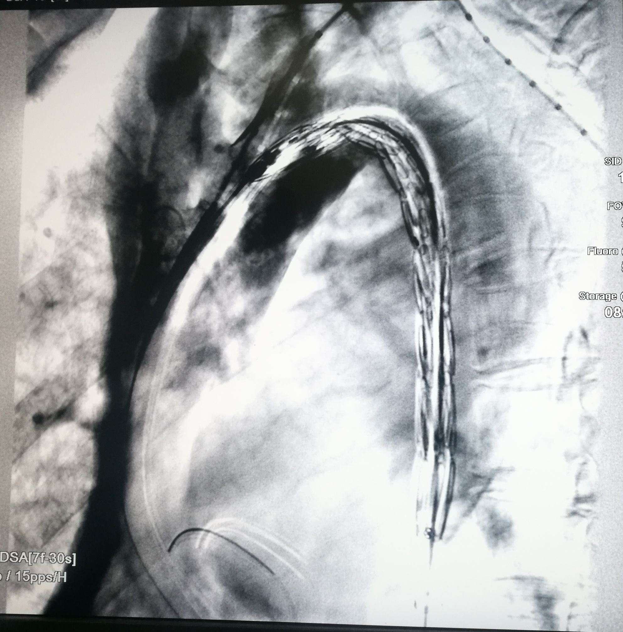 一例凶险主动脉夹层的超声诊断,慢性夹层直径超过5厘米