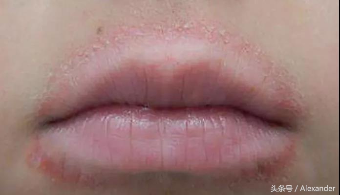 嘴唇脱皮干裂用什么唇膏,冬天嘴唇干裂没有唇膏怎么办