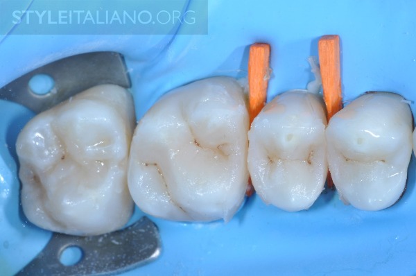 后牙修补贴片,后牙全瓷修复图片