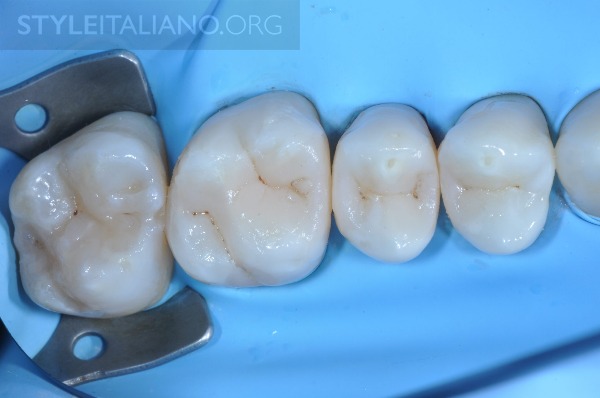 后牙修补贴片,后牙全瓷修复图片