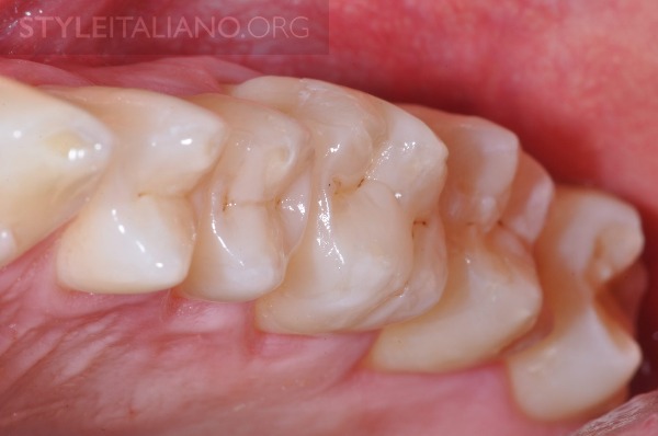 后牙修补贴片,后牙全瓷修复图片