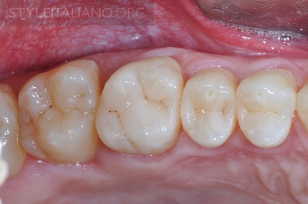 后牙修补贴片,后牙全瓷修复图片