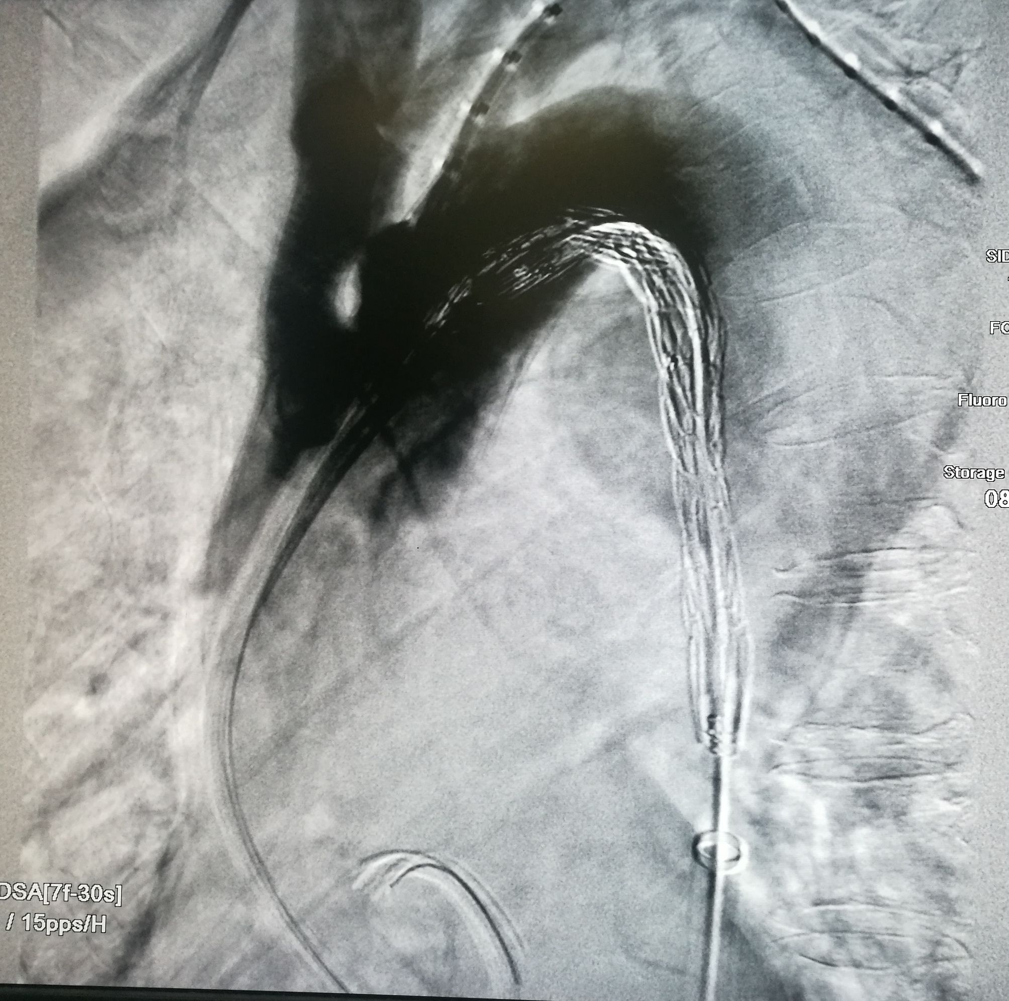 一例凶险主动脉夹层的超声诊断,慢性夹层直径超过5厘米