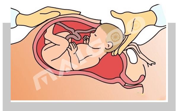 纠结顺产还是剖腹产,顺产还是剖腹产需要去医院评估吗