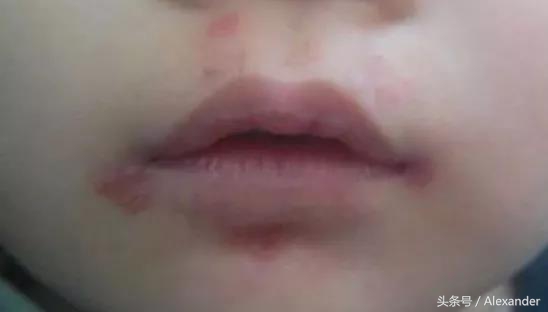 嘴唇脱皮干裂用什么唇膏,冬天嘴唇干裂没有唇膏怎么办