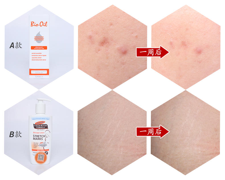 产妇彻底打败妊娠纹全攻略,产后妊娠纹修复橄榄油