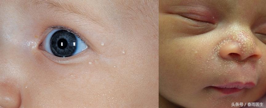 眼睛长了脂肪粒什么产品有效,眼周围长脂肪粒和护肤品有关吗