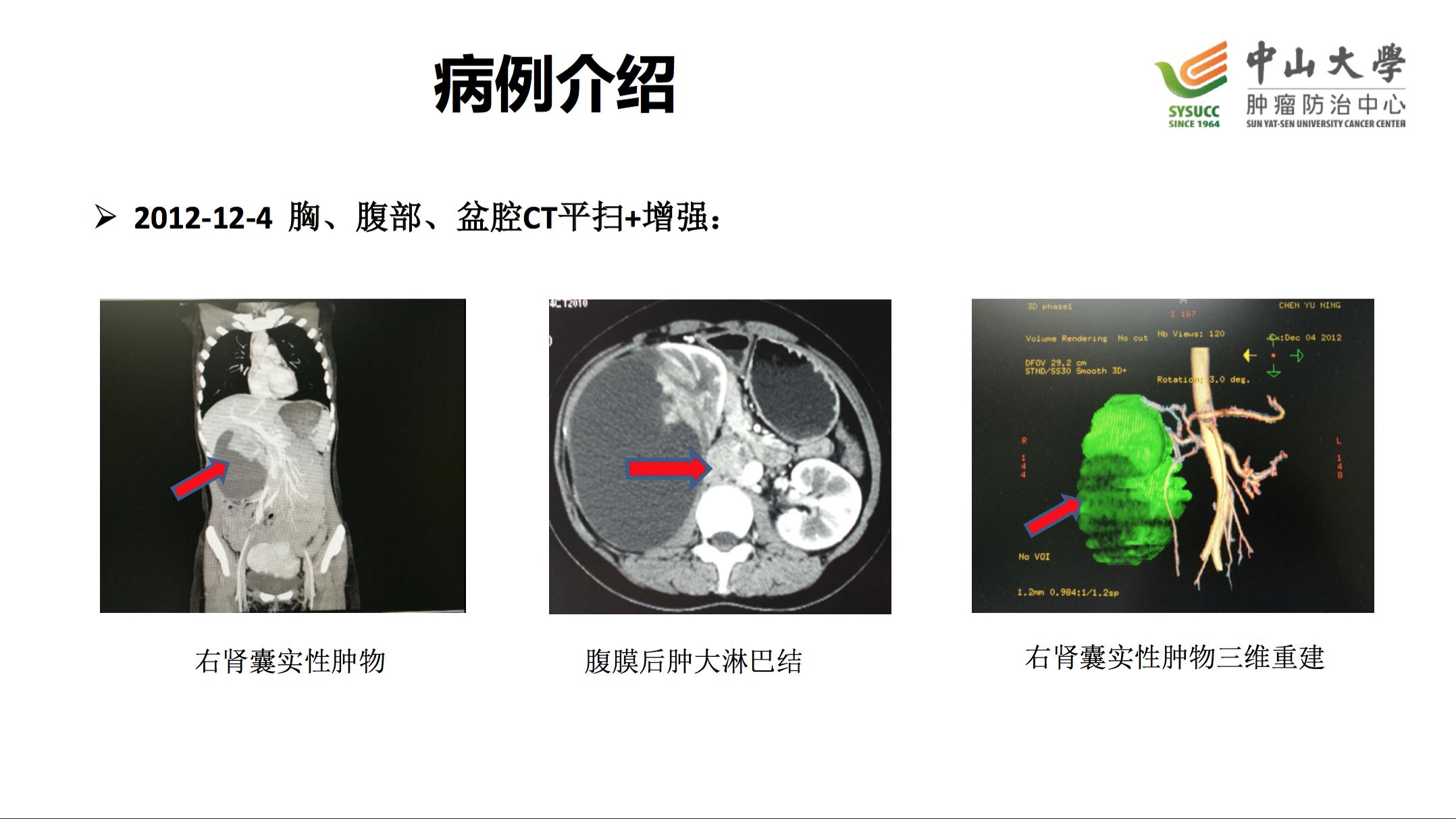 阿昔替尼联合pd-1治疗肾癌,肾癌阿昔替尼耐药后怎么治疗