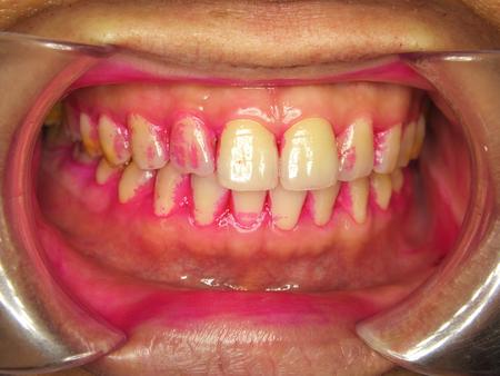 牙龈肿痛吃晚饭可以吃什么,胃口不舒服也能引起牙龈肿痛吗