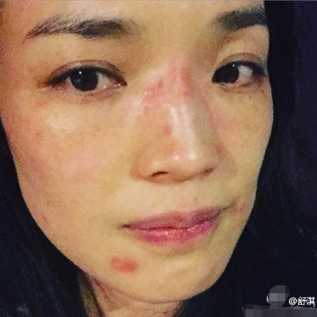 舒淇过敏都用什么护肤品呢,紫外线过敏舒淇