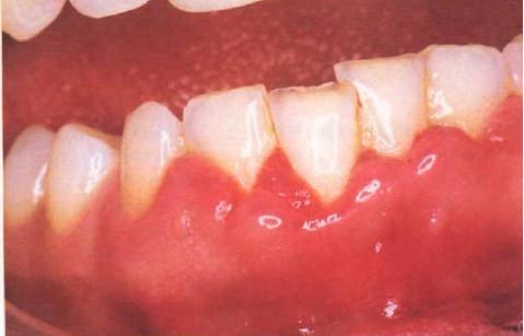 牙龈肿痛吃晚饭可以吃什么,胃口不舒服也能引起牙龈肿痛吗