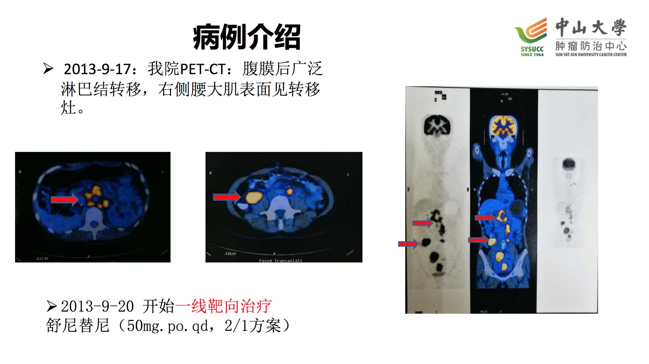 阿昔替尼联合pd-1治疗肾癌,肾癌阿昔替尼耐药后怎么治疗
