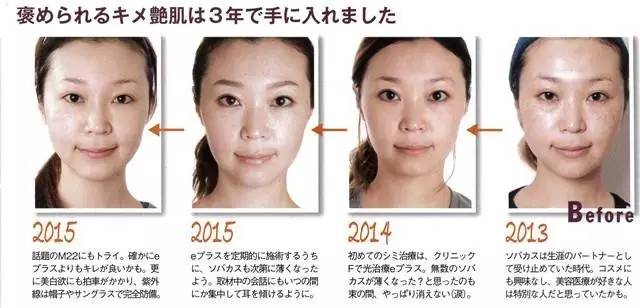 面部常见四类斑点如何正确祛斑,斑点在脸上该怎么去除