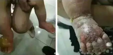 阿娇刮痧后背效果,阿娇被吓哭