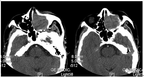 73岁患者因左鼻塞流脓涕4个月入院，CT发现一软组织高低混杂密度，怎么诊断？