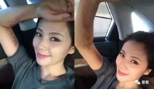 阿娇刮痧后背效果,阿娇被吓哭