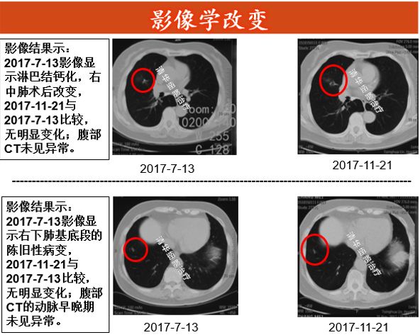 肺癌与黑色素瘤治疗,黑色素瘤导致的肺癌