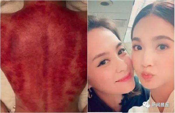 阿娇刮痧后背效果,阿娇被吓哭