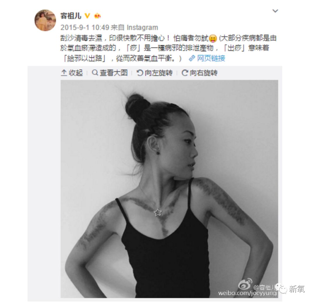 阿娇刮痧后背效果,阿娇被吓哭