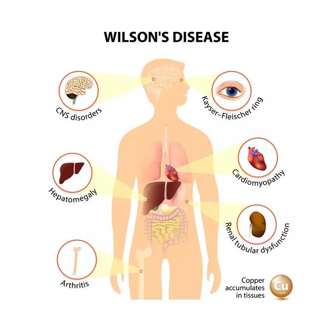 小儿肝豆状核变性患者样子,肝豆状核变性的孩子寿命短吗