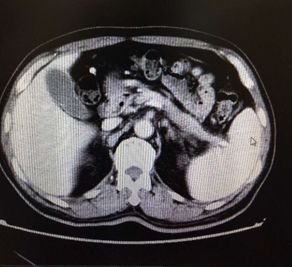 出血原因千千万，此例患者为哪般？