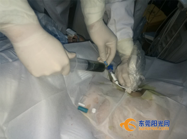 东莞：肚子痛差点要了五旬阿姨的命？真凶竟是那些不起眼的小石头！