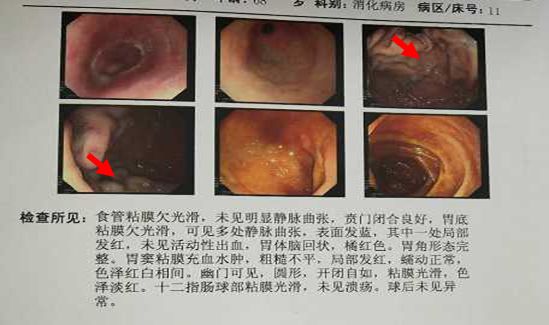 出血原因千千万，此例患者为哪般？