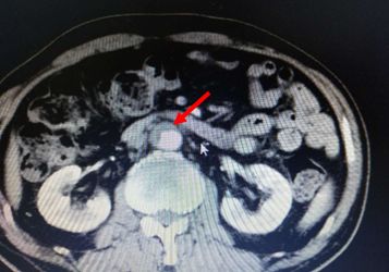 出血原因千千万，此例患者为哪般？
