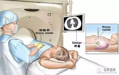 北京医院肿瘤微创介入中心,北京肿瘤医院有微创介入治疗的吗