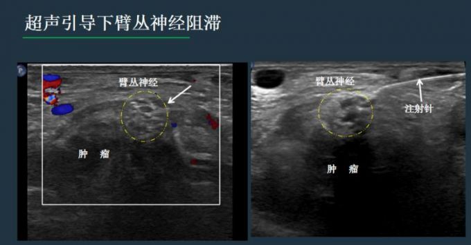 成都医生用“催眠神经”疗法为癌症患者缓解疼痛