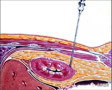 北京医院肿瘤微创介入中心,北京肿瘤医院有微创介入治疗的吗