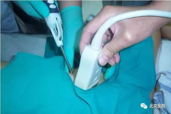 北京医院肿瘤微创介入中心,北京肿瘤医院有微创介入治疗的吗